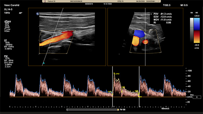 Ejemplo de una imagen recuperada con ecograf&iacute;a vascular Doppler xPlane de Philips