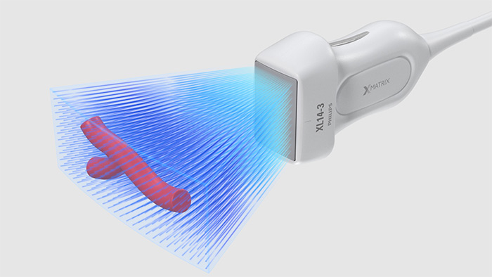 Transductor de array lineal XL14-3 xMATRIX para evaluaciones vasculares de Philips con capacidades 3D/4D de f&aacute;cil uso
