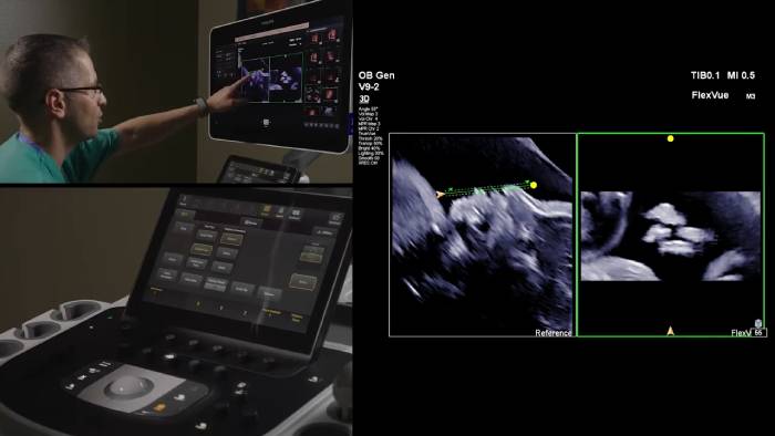 Demostraci&oacute;n del transductor V9-2 para ultrasonidos 3D de Philips