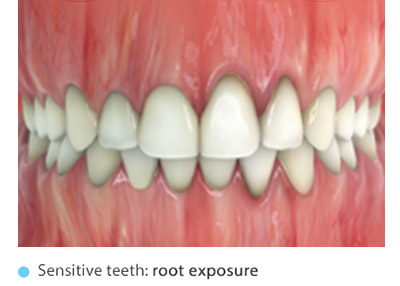 Reducir la sensabilidad dental
