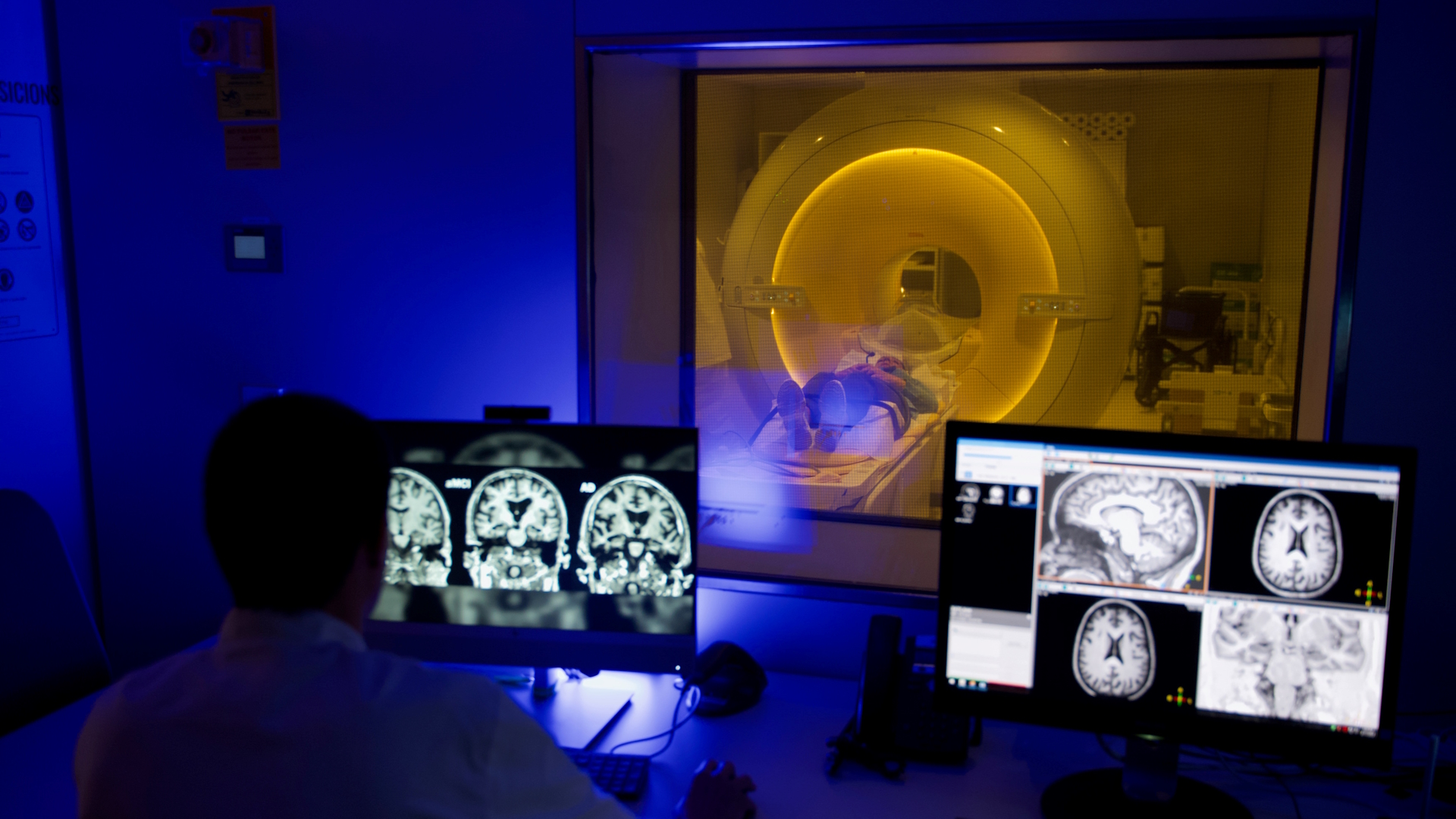 El flujo sangu&iacute;neo del cerebro disminuye en etapas asintom&aacute;ticas del Alzheimer